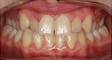 After Orthodontist Treatment Image 1