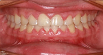 After Orthodontist Treatment Image 2